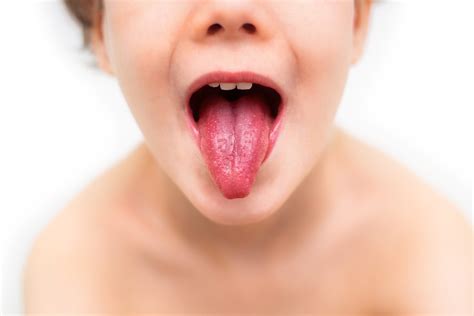 Scarlet Fever and Streptococcal Infections - What Are They?