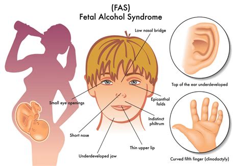 Fetal Alcohol Syndrome in Adults: Symptoms & Effects | Casa Capri