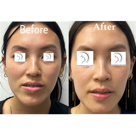 Face Alignment Surgery