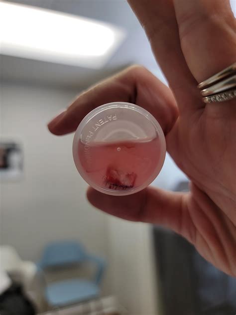 Thoughts on my scar healing process? : r/Dermatology