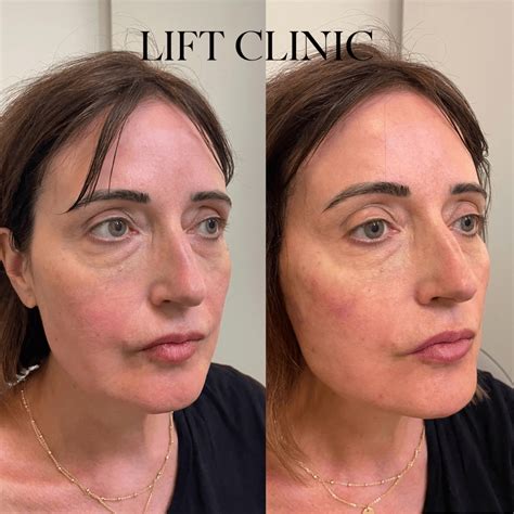 Hyaluronic Acid Filler Jawline at Anthony Tryon blog