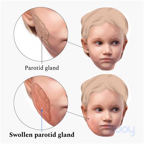 Glandula Parotida Inchaco Caxumba PDF) Parotidite Aguda Em Jovem