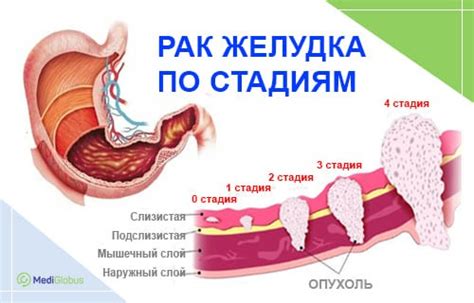 Что нужно знать про рак желудка – стадии и лечение | Medical Tourism ...