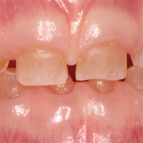 Dentinogenesis Imperfecta - Dr Ellie Nadian
