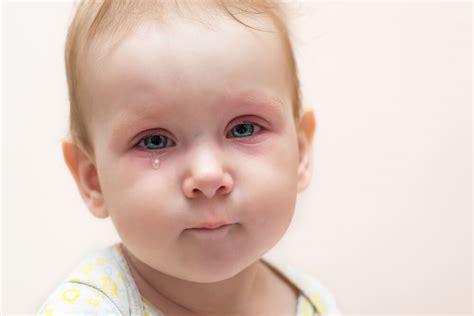 Eye Swelling In Toddlers at Pauline Dane blog