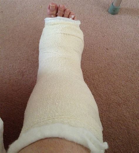 Broken Ankle Cast