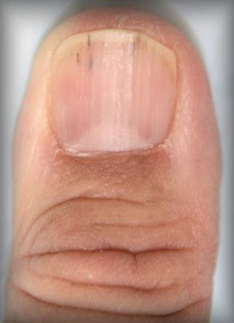 Nutrition and nail disease - Clinics in Dermatology