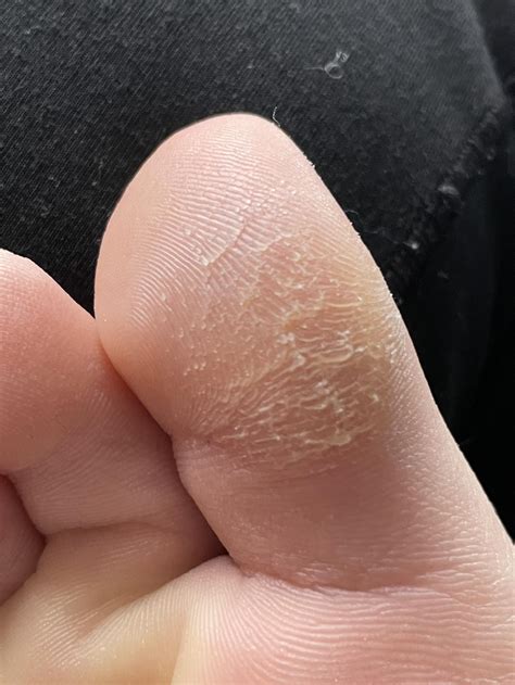 Toe Skin Peeling Skin Peeling Between The Toes: What It Means