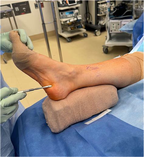 Plantar Fascia Tendon Procedure