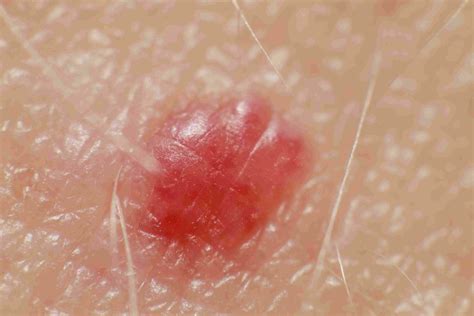 Cherry Angioma: Gejala, Penyebab, dan Pengobatan