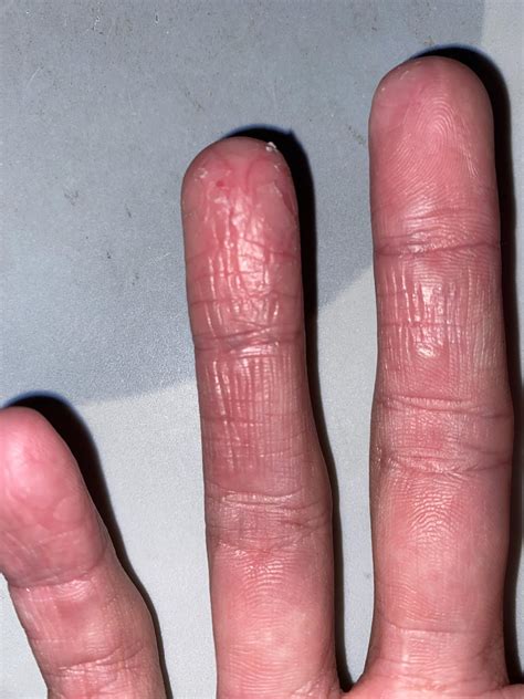 Dry and Cracked Fingers! : r/DermatologyQuestions