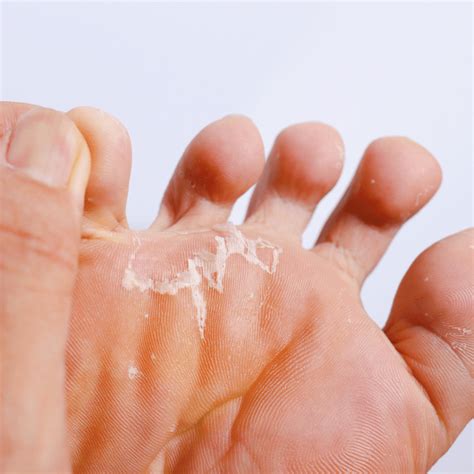 Athlete's Foot Treatment Before And After at Liam Dun blog