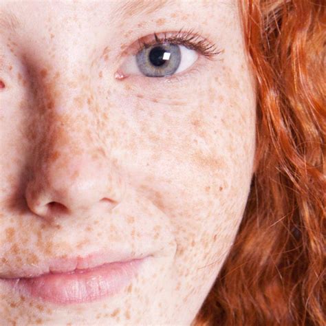 Freckles After Sun Exposure at Karima Parker blog