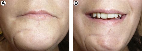 A Modified Lip Split Incision - Journal of Oral and Maxillofacial Surgery