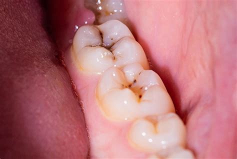 Goodbye, Cavities? Scientists Just Found a Way to Regrow Tooth Enamel
