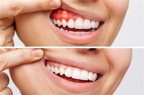 Healthy Gums vs. Unhealthy Gums