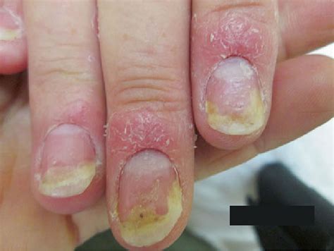 Ridges In Fingernails Psoriasis at Laura Chamberlain blog