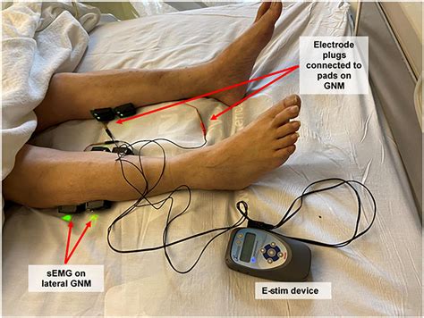 E Stim Electrode Placement