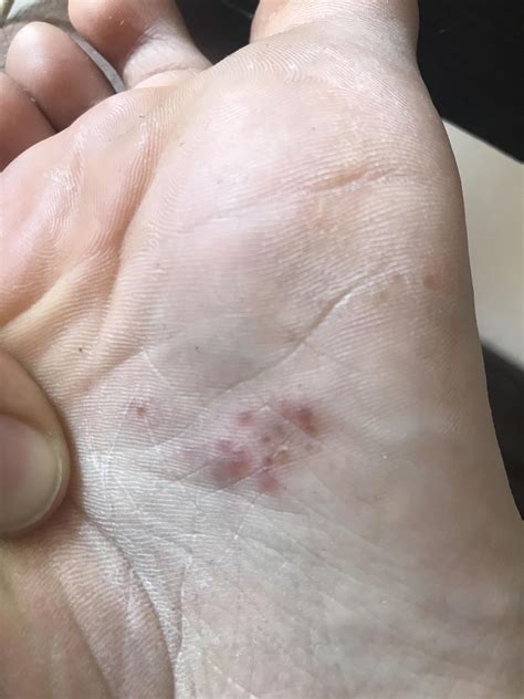 Cluster Of Bumps On Foot Online | emergencydentistry.com