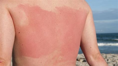 Spot This Rash–Summertime– Sun Sensitivity - Sutton Dermatology ...