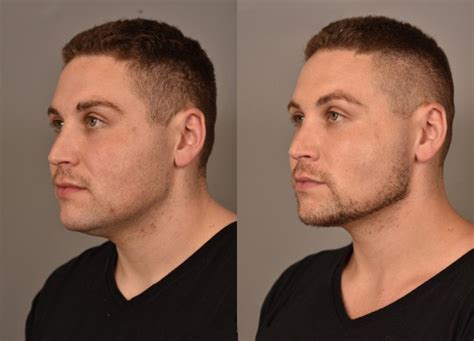 Buccal Fat Removal Under Chin at Ruth Leet blog