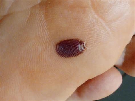 Melanoma or blood blister : r/Melanoma