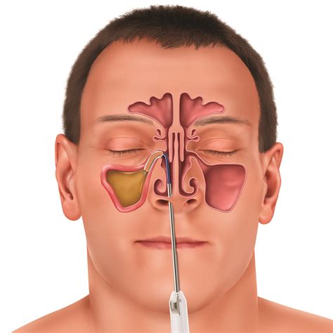 Allergy Season has Orange County Patients Lined Up For A New In-Office Sinus Treatment That ...