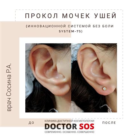 Прокол ушей | Клиника Инновационной Косметологии DoctorSOS
