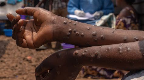 How Does Mpox Spread, and Who Is Most at Risk? - The New York Times