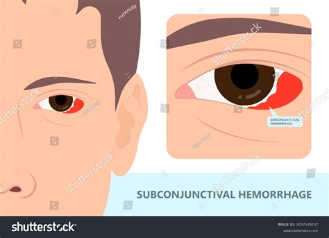 Subconjunctival Hemorrhage Diagram Subconjunctival Hemorrhage (broken