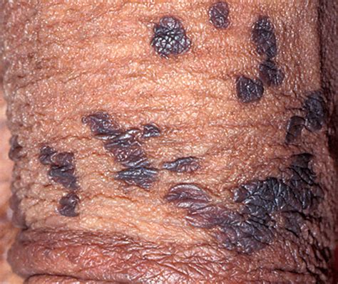 Penile dermatoses: accurate diagnosis prevents serious sequelae ...