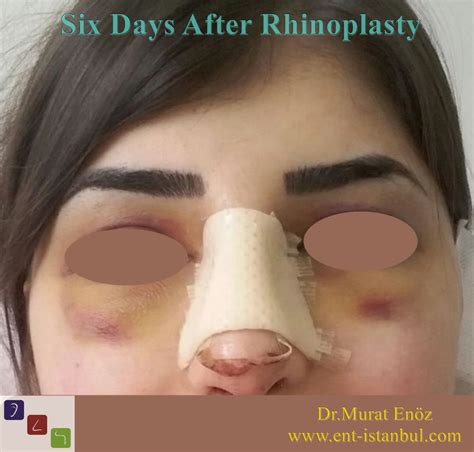Rhinoplasty Healing Properties by Week and Month