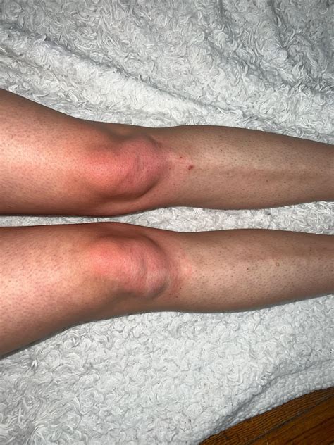 Red knees/feet with some swelling (pictures) : r/PsoriaticArthritis