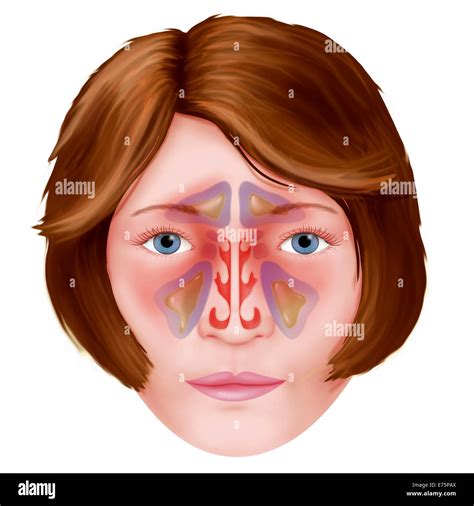 Sphenoidal sinus hi-res stock photography and images - Alamy