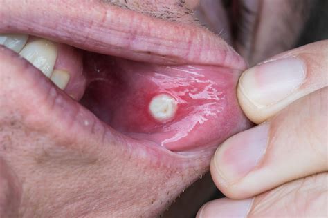 Blister Inside Mouth Cheek
