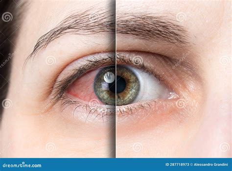 Red Eye before and after Treatment Stock Image - Image of conjunctivitis, infected: 287718973