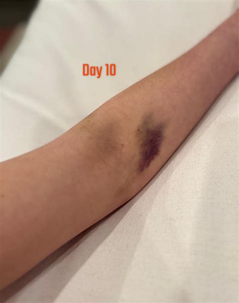 Bad bruising 10 days after blood draw - anemic and have Vasculopathy ...