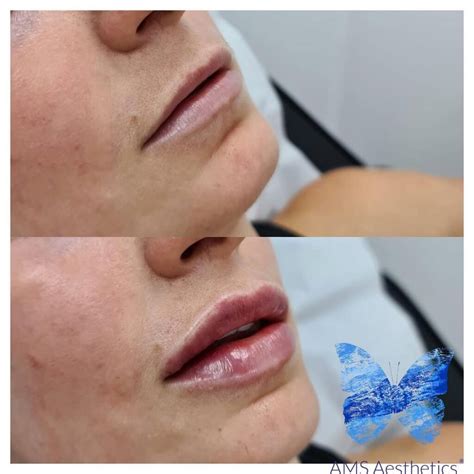 1 Ml Lip Filler