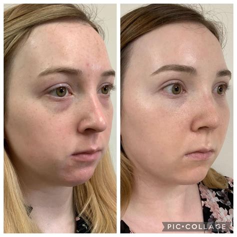 Rhinoplasty, Sub-Brow Lift, Under Eye Fat Transfer - Before and After (1 Month Post-Op) : r ...