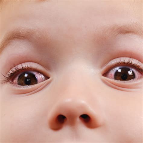 Eyes Crusted Shut Baby at Roger Marino blog