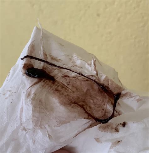 Clots During Implantation Bleeding Implantation Bleeding: What You