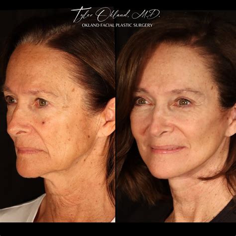 Dr. Tyler Okland, MD | One of my absolute favorite patients came in for post op last week... I ...