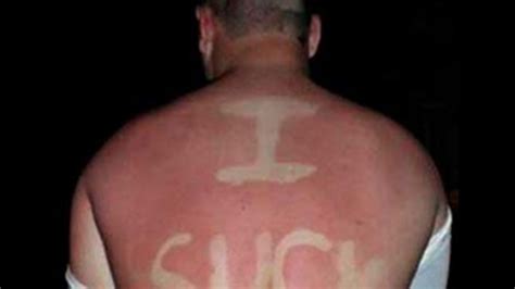 TMZ's Summer Sunburn Snapshots Contest