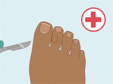 How to Remove Corns from Your Toes: 12 Steps (with Pictures)