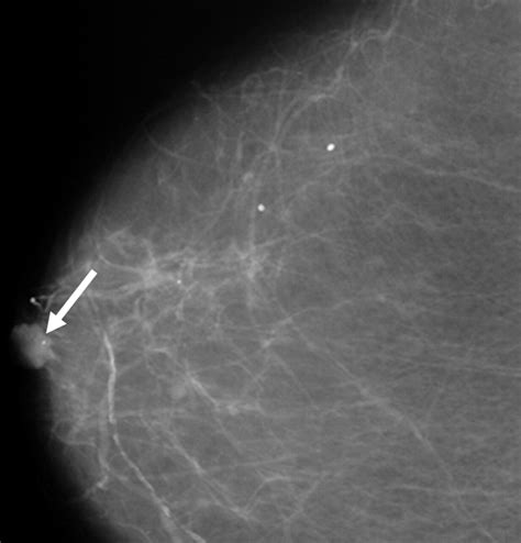 Why Are There Black Spots On My Nipple at Armand Dunn blog