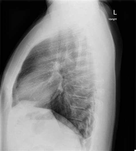Normal CXR: AP and Lateral - JETem