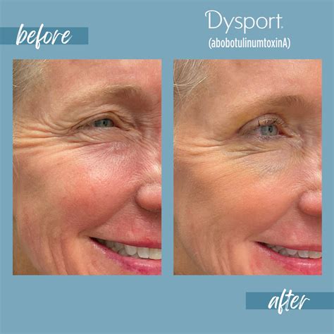 Dysport Denver | Dysport Injections Denver, CO