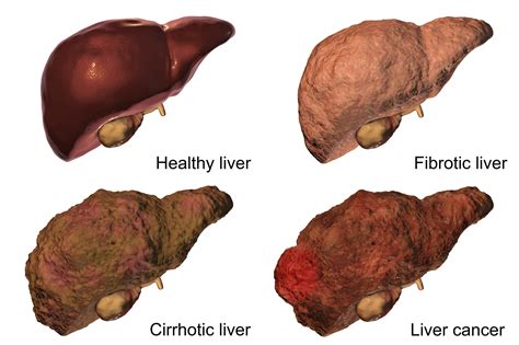 Liver Cancer Pictures