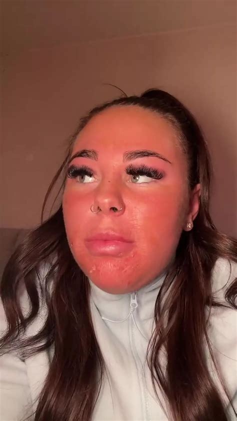 Influencer burns skin off face after attempting horrifying sun bed ...