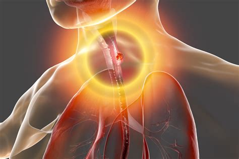Clinical Presentation and Diagnosis of Esophageal Cancer - Surgery 101